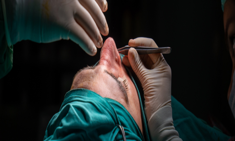 What to Ask Your Specialist About Open Septorhinoplasty and Preservation Rhinoplasty in London
