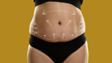 What to Consider When Booking a Plus Size Tummy Tuck in London at Delta Clinics