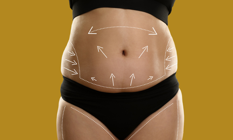 What to Consider When Booking a Plus Size Tummy Tuck in London at Delta Clinics